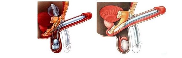 prosthesis for penis enlargement