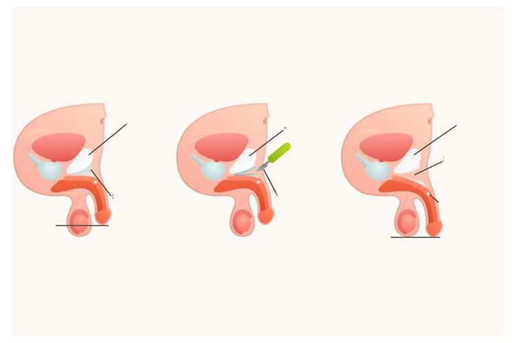 How the penis enlargement surgery is performed