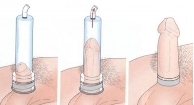Penis enlargement using a pump