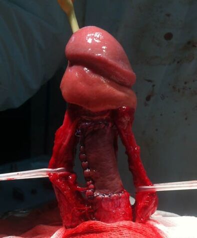 Penile enlargement surgery